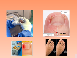 How to help children with painful toenails safely How to help children with painful toenails safely